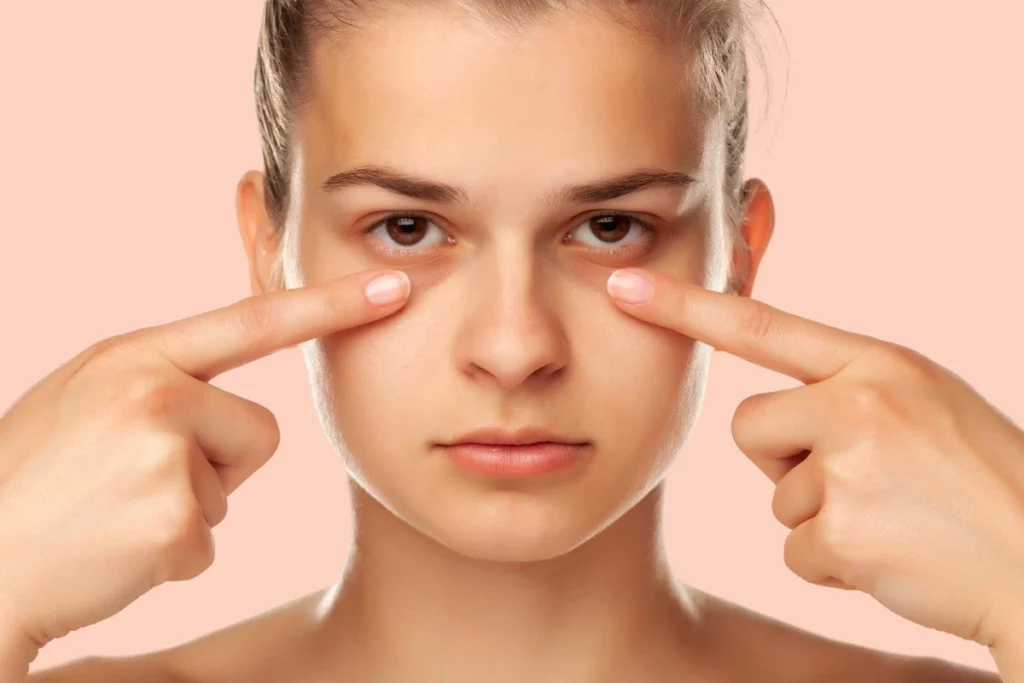 تیرگی دور چشم و سیاهی زیر چشم